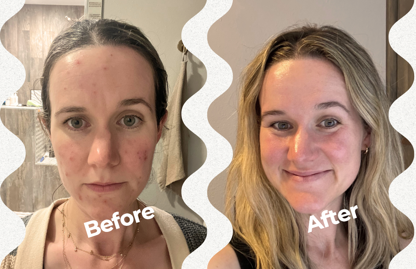 Before and after photos showing skin transformation from autoimmune disease and acne to clear, healthy skin